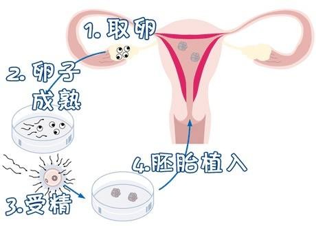 安孕冻胚移植专科